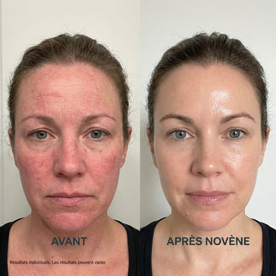 Kit Micro-Infusion™ | Novène