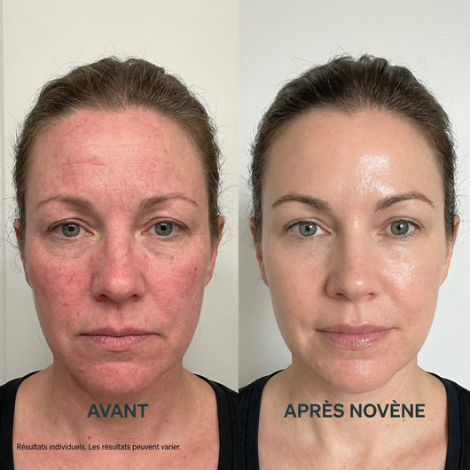 Kit Micro-Infusion™ | Novène